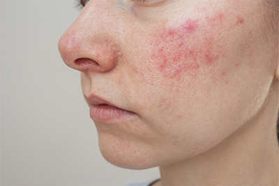 Rosacea